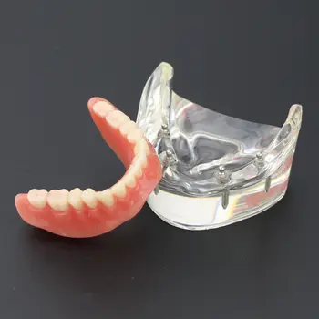 1 бр. Стоматологичен Модел за изучаване на зъбите Overdenture Inferior 4 Демонстрационен Модел на Импланта 6002 02